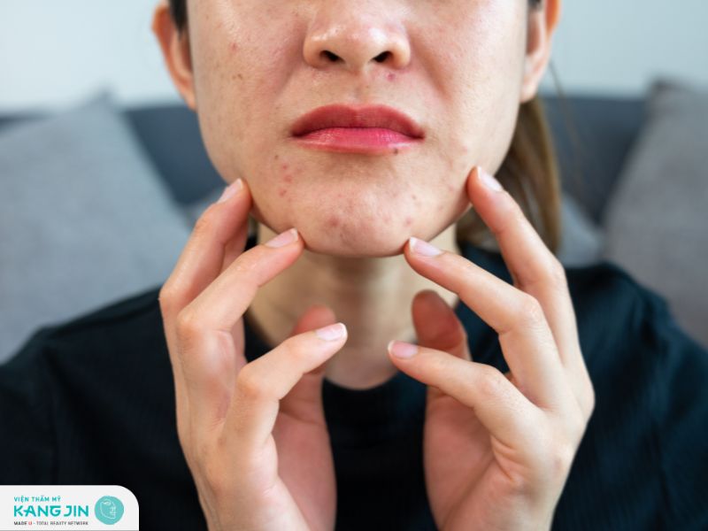 Hướng dẫn cách chăm sóc da dầu mụn lỗ chân lông to tại nhà 