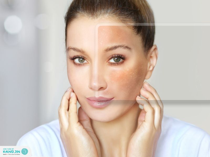 da bị nám nhẹ là do đâu