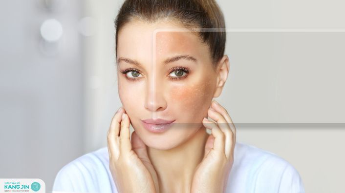 da bị nám nhẹ là do đâu