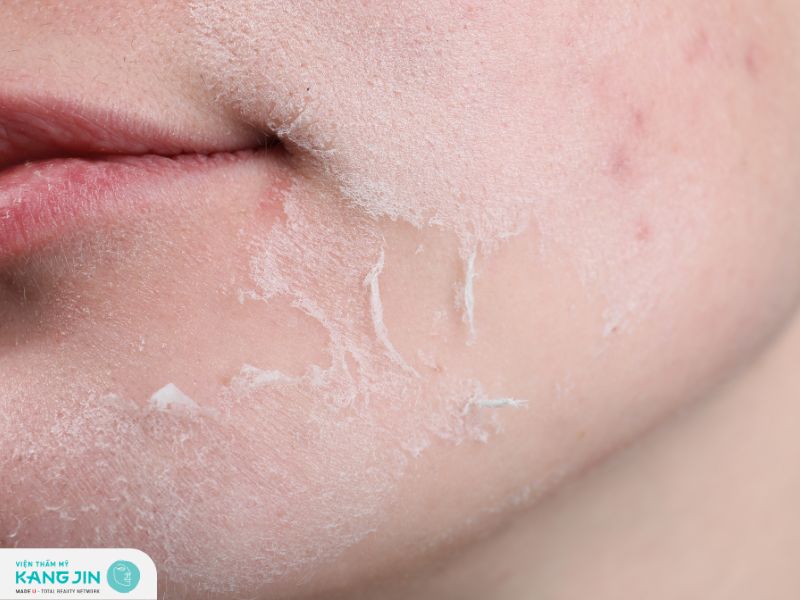 Da khô bong tróc là một trong những dấu hiệu cho thấy da đang bị kích ứng mỹ phẩm 