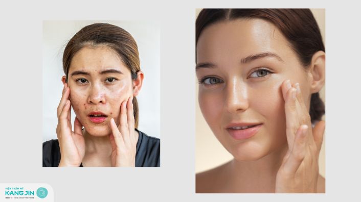 Da dầu và da nhờn khác nhau như thế nào? Hướng dẫn chăm sóc da