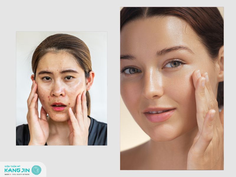 Da dầu và da nhờn khác nhau như thế nào?