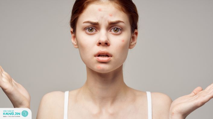Rối loạn nội tiết tố khiến da mặt đột nhiên nổi nhiều mụn