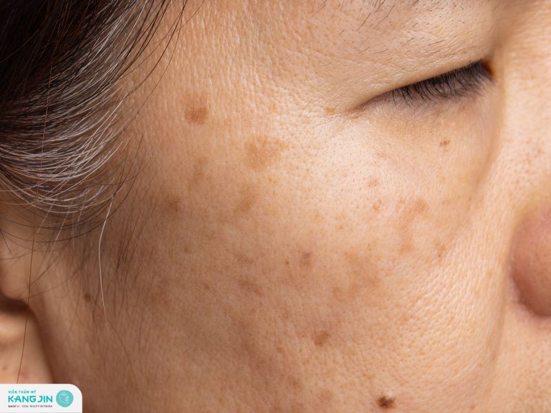 da nổi đốm nâu không ngứa