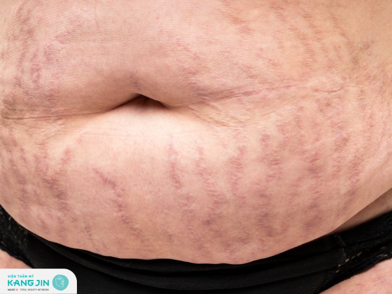 Làm thế nào để ngăn ngừa vết rạn da hình thành?