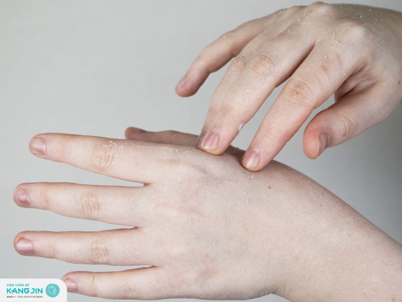 da tay bị bong tróc do thiếu chất gì