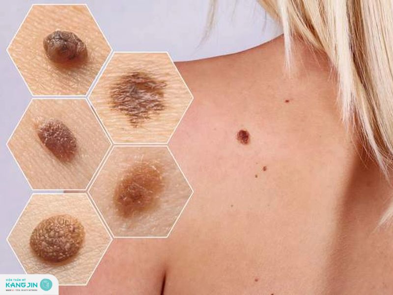 dấu hiệu ung thư da