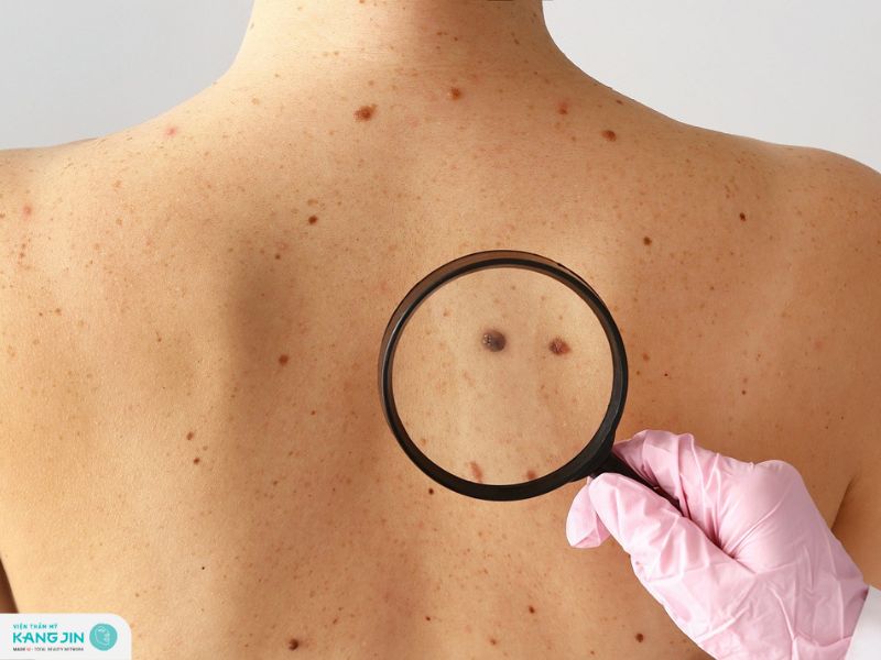 dấu hiệu ung thư da