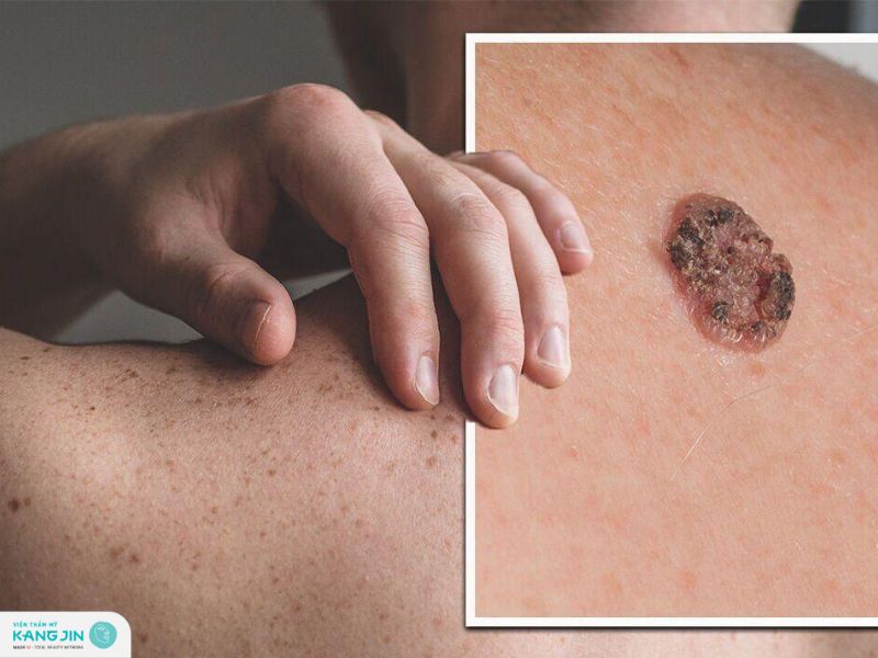 cách phòng chống bệnh ung thư da