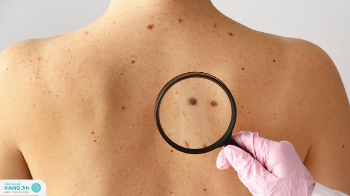 dấu hiệu ung thư da