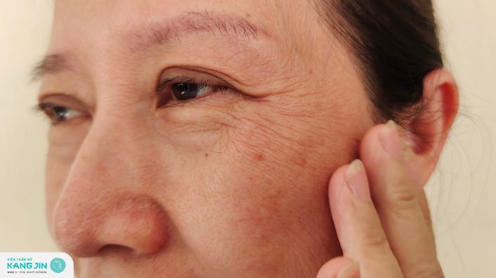 Tìm hiểu do đâu da mắt nhăn nheo và giải pháp khắc phục