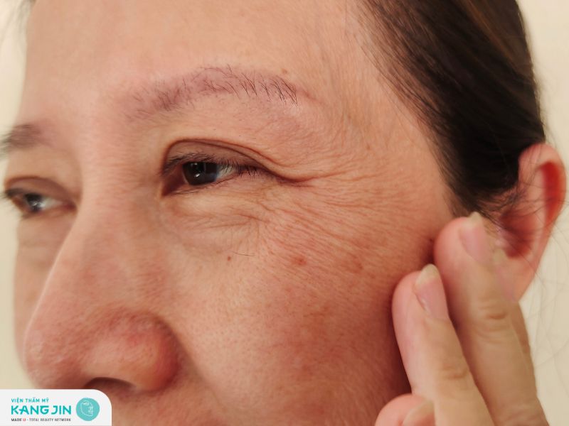 Khám phá nguyên nhân do đâu da mắt nhăn nheo và cách khắc phục