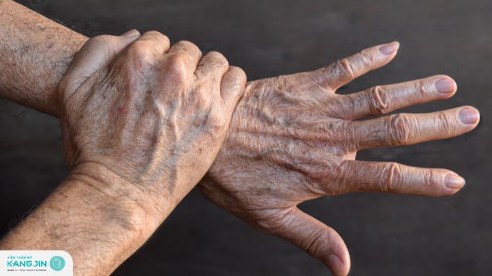 Đồi mồi là gì? Nguyên nhân, cách điều trị và phòng tránh