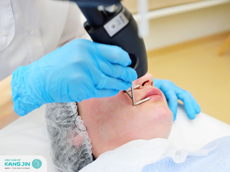 Xóa nếp nhăn khóe miệng bằng laser 