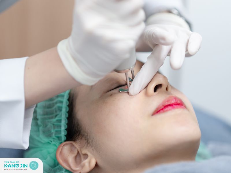 phương pháp laser