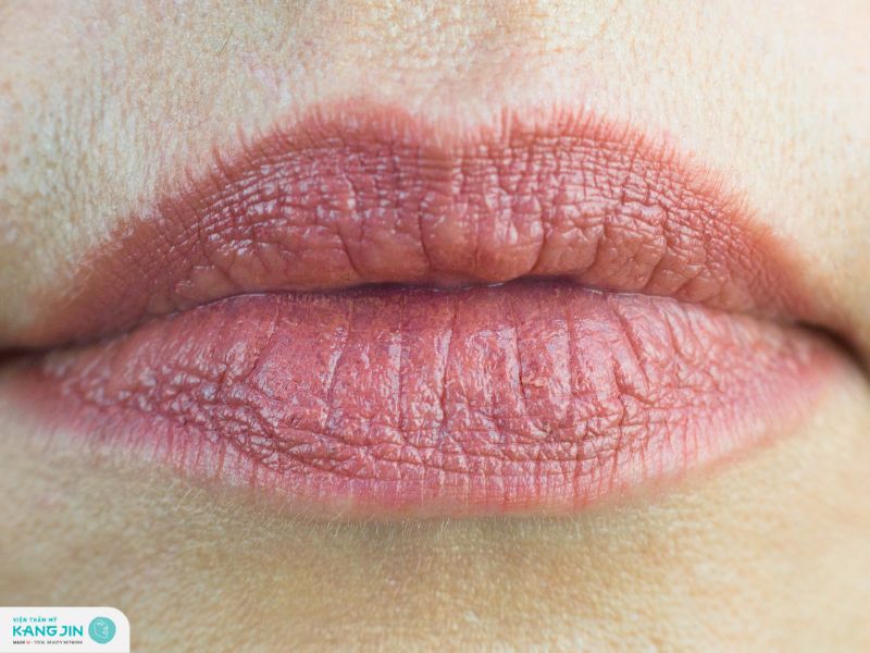 môi nhiều nếp nhăn