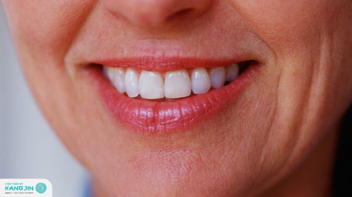 Tạm biệt nếp nhăn khóe miệng với những phương pháp đỉnh cao