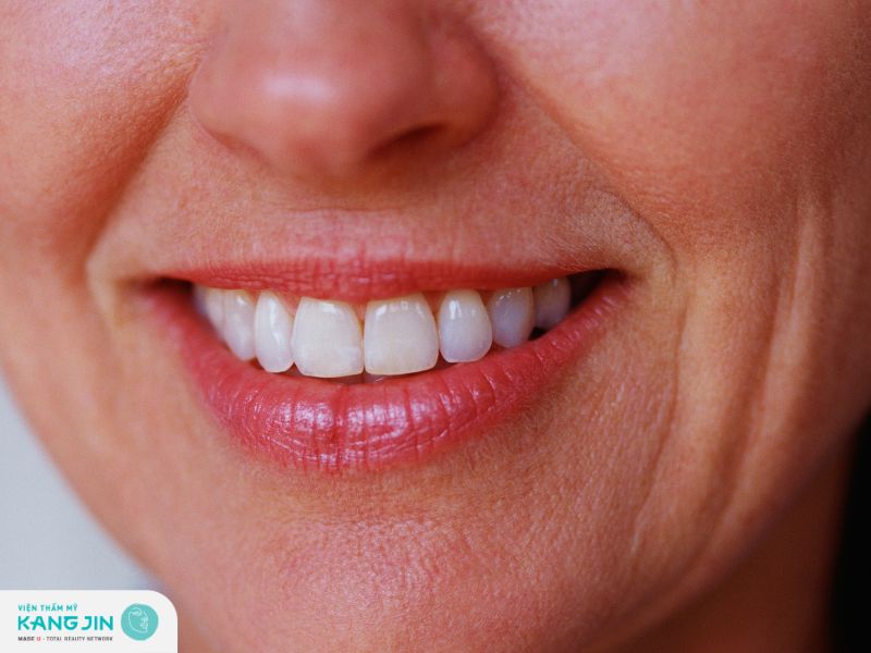 Nếp nhăn khóe miệng