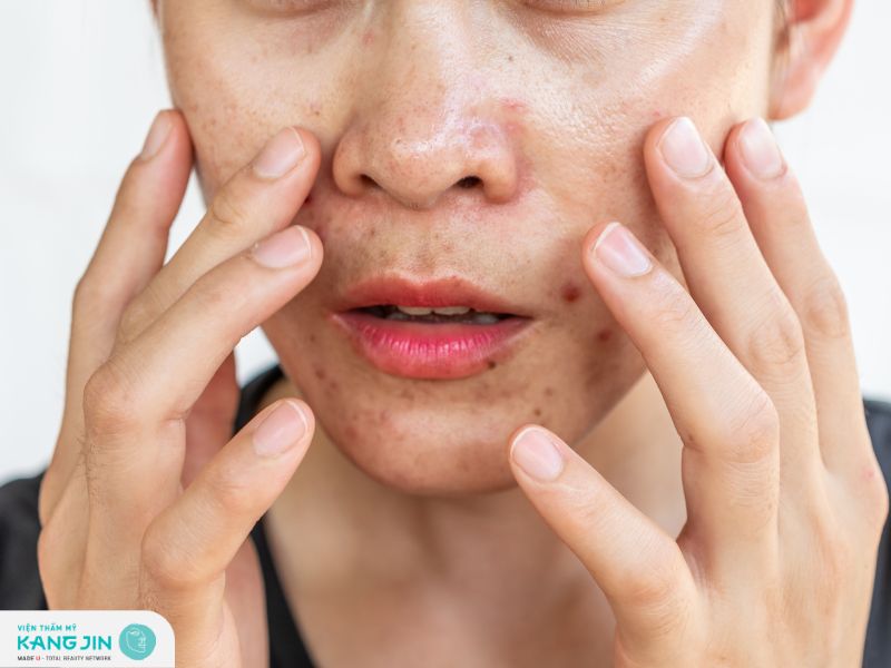 Các nguyên nhân gây da dầu mà bạn nên biết