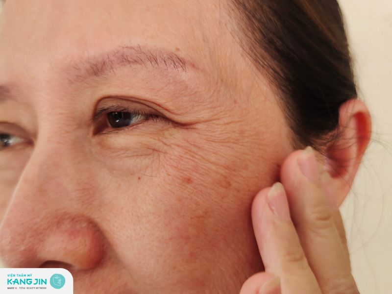 nguyên nhân hình thành nếp nhăn vùng mắt
