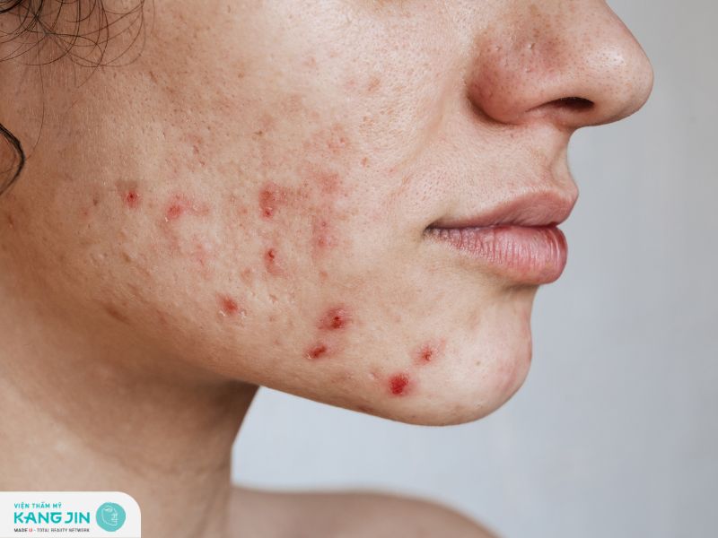 Nguyên nhân phổ biến gây tăng sắc tố sau viêm là gì?