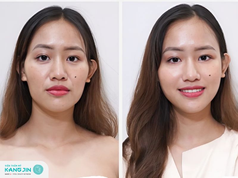 Nguyên nhân và cách khắc phục má hóp