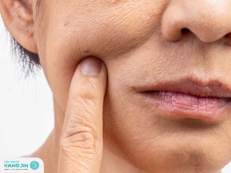 Những vùng da dễ xuất hiện nếp nhăn