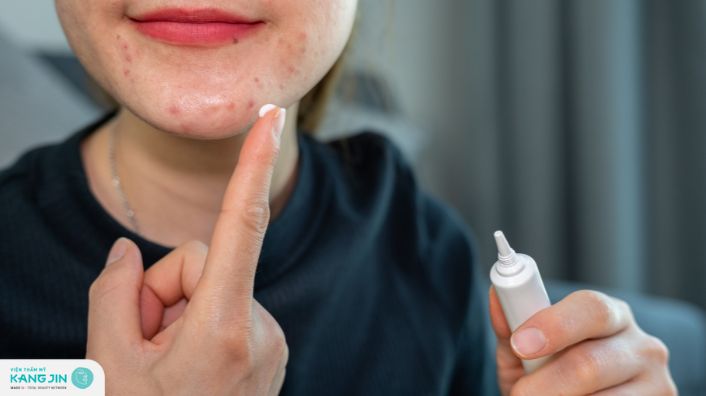 Quy trình các bước phục hồi da sau nặn mụn đúng chuẩn y khoa