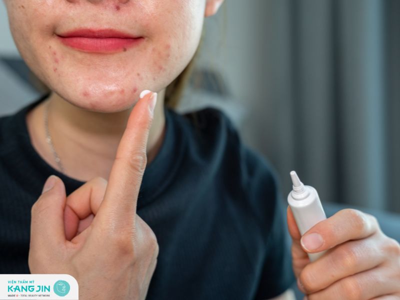 Quy trình các bước phục hồi da sau nặn mụn đúng chuẩn