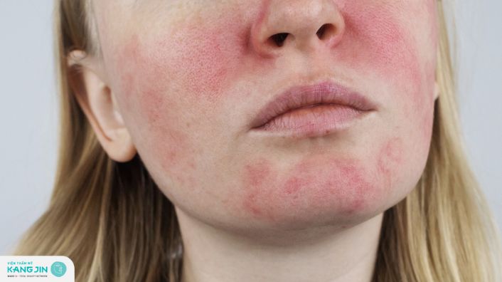 Tại sao da mặt bị đỏ? Cách điều trị giúp làn da rạng rỡ và đều màu
