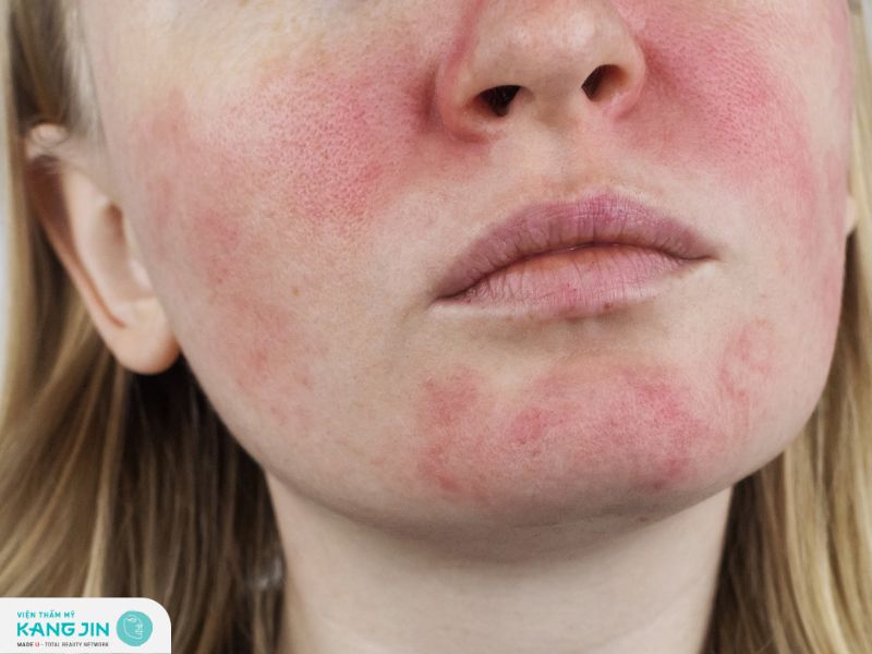 Tại sao da mặt bị đỏ?