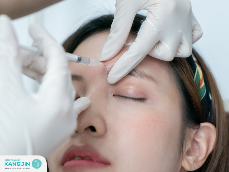 Tiêm filler xóa nếp nhăn ấn đường