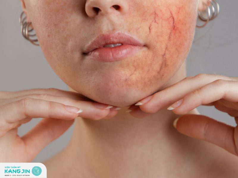 Tình trạng da mỏng lộ mao mạch là gì?