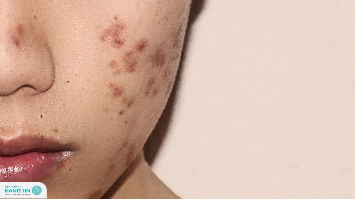 vết thâm mụn mãi không hết phải làm sao