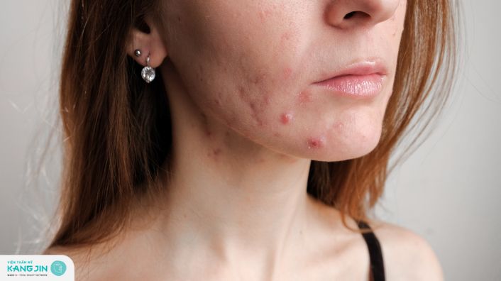 Vì sao mụn hay tái phát? 5 cách ngăn ngừa mụn hay tái phát hiệu quả