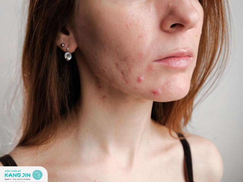 Vì sao mụn hay tái phát?