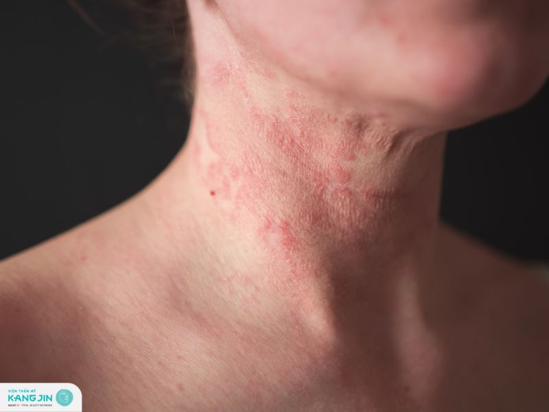 viêm da tiếp xúc là gì