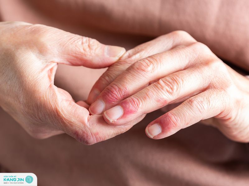 biến chứng của bệnh viên da tiếp xúc