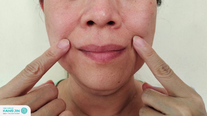 Bí kíp “thần thánh” giúp xóa rãnh cười sâu dễ dàng hơn bao giờ hết