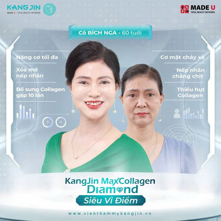 Chị Bích Nga thực hiện xóa nếp nhăn trán tại Viện thẩm mỹ KangJin