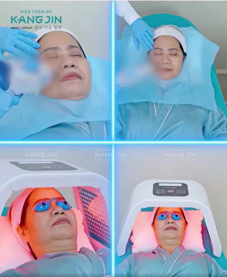 quy trình thực hiện liệu pháp kangJin maxcollagen diamond siêu vi điểm