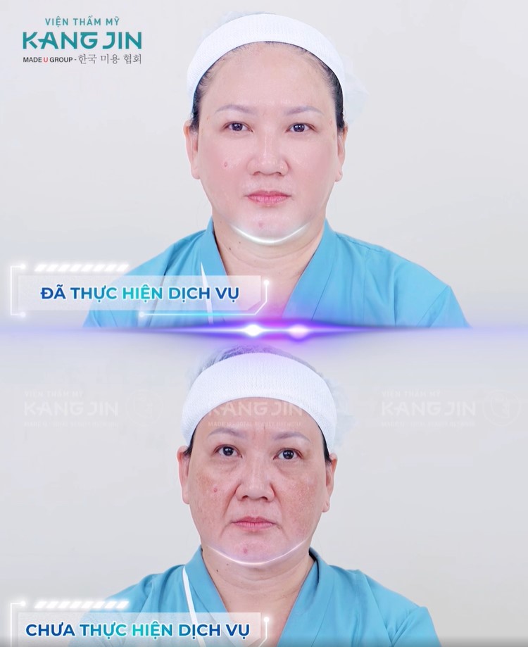 Hình ảnh trước và sau khi thực hiện liệu pháp KangJin Maxcollagen Diamond Siêu Vi Điểm 
