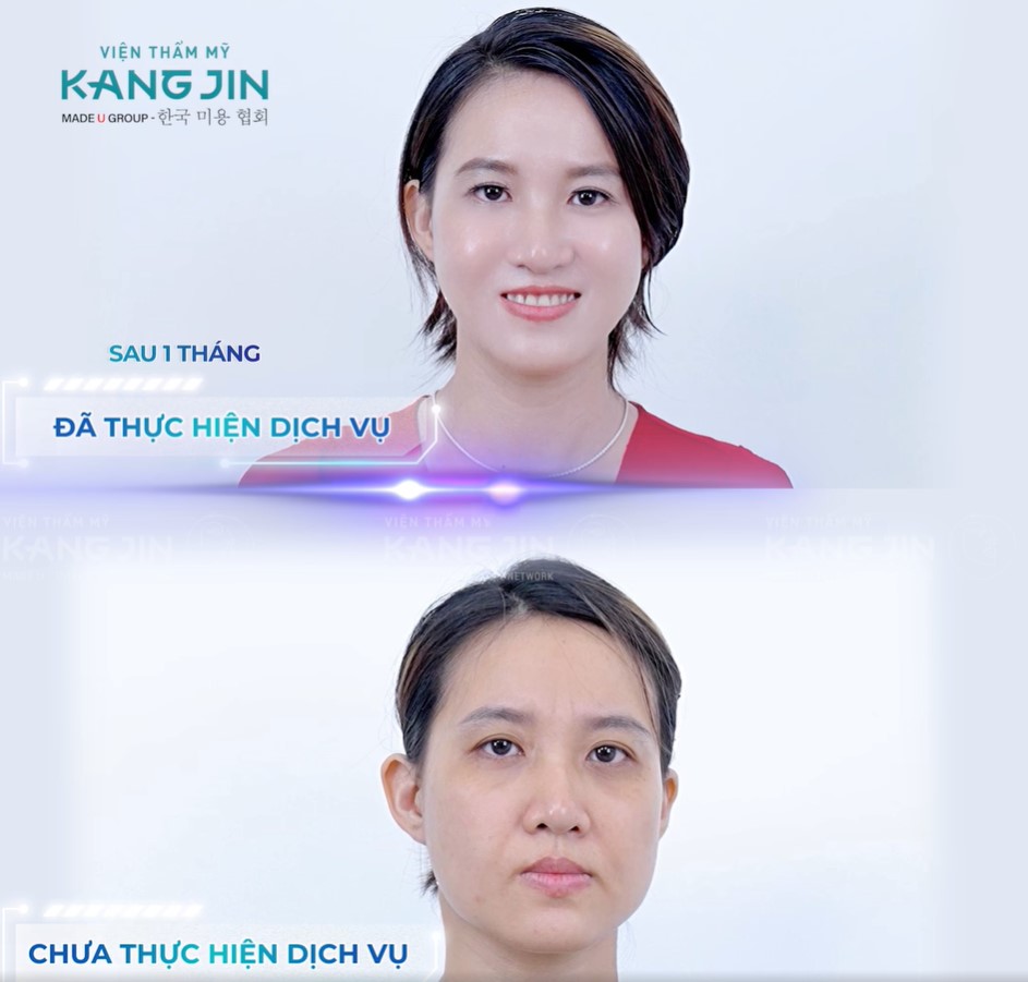 Hình ảnh trước và sau khi thực hiện trẻ hóa bằng KangJin Maxcollagen Diamond Siêu Vi Điểm