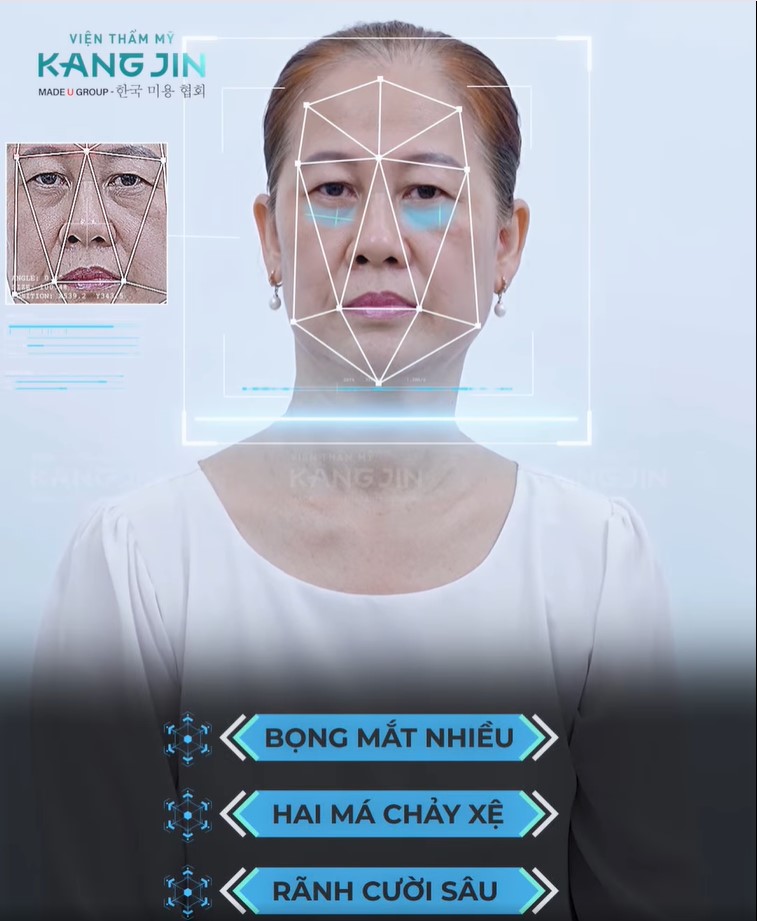 cô Bích Na trước liệu trình