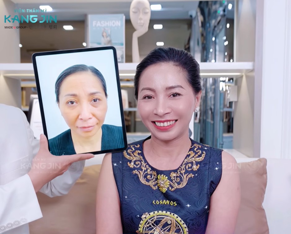 Hình ảnh so sáng trước và sau khi chị Hoàng Dung thực hiện trẻ hóa da KangJin Maxcollagen Diamond Siêu Vi Điểm