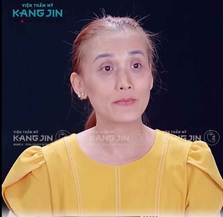 Tình trạng da lão hóa rõ rệt của chị Loan trước khi thực hiện liệu trình 