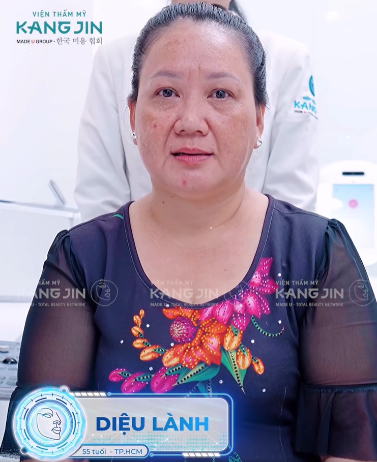Làn da lão hóa nặng của chị Diệu Lành trước khi thực hiện trẻ hóa 