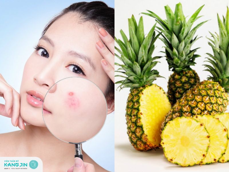 dùng dứa để trị mụn