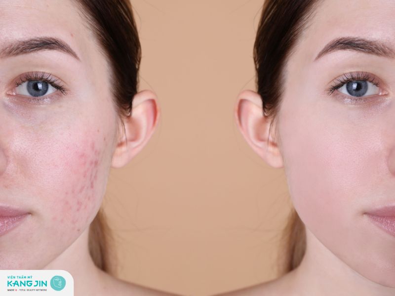 giảm mụn kháng viêm hiệu quả