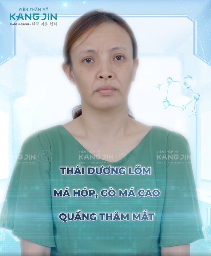 chị Hanah trước liệu trình
